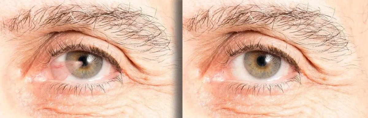 Comparison of blurred and clear vision after refractive surgery